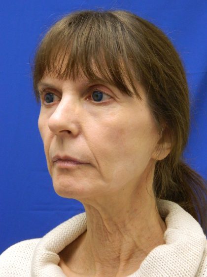 Face/Neck Lift Before & After Patient #8304