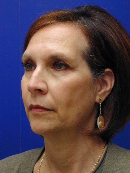 Face/Neck Lift Before & After Patient #8446