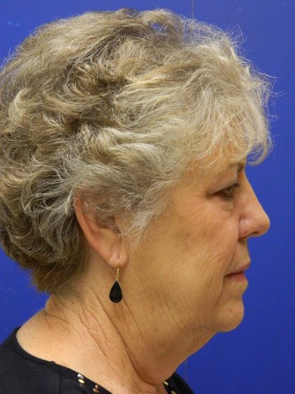 Face/Neck Lift Before & After Patient #8470