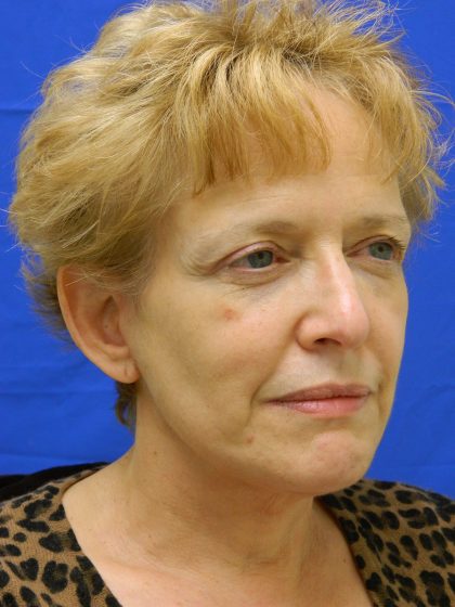 Face/Neck Lift Before & After Patient #8293