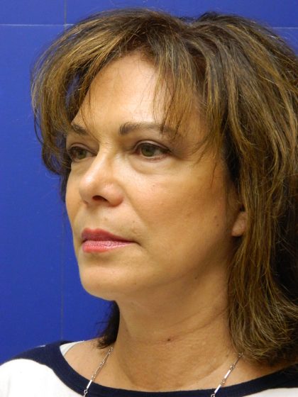 Face/Neck Lift Before & After Patient #8341