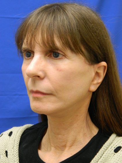 Face/Neck Lift Before & After Patient #8304
