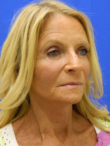 Face/Neck Lift Before & After Patient #8479