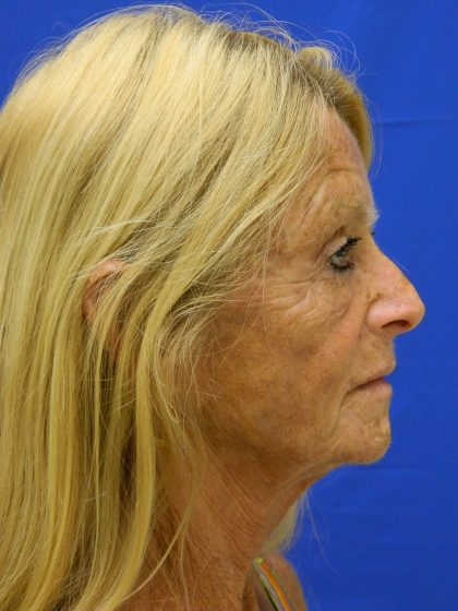 Face/Neck Lift Before & After Patient #8479