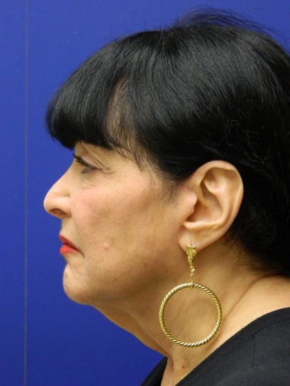 Face/Neck Lift Before & After Patient #8315
