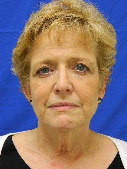 Face/Neck Lift Before & After Patient #8293
