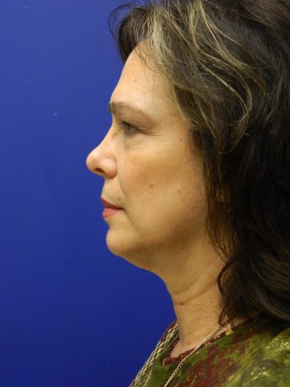 Face/Neck Lift Before & After Patient #8341