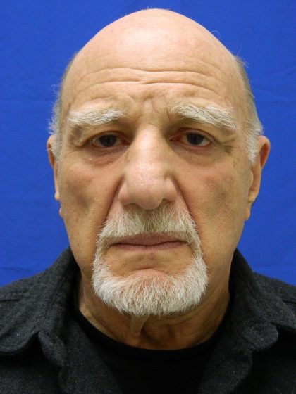 Face/Neck Lift Before & After Patient #8361
