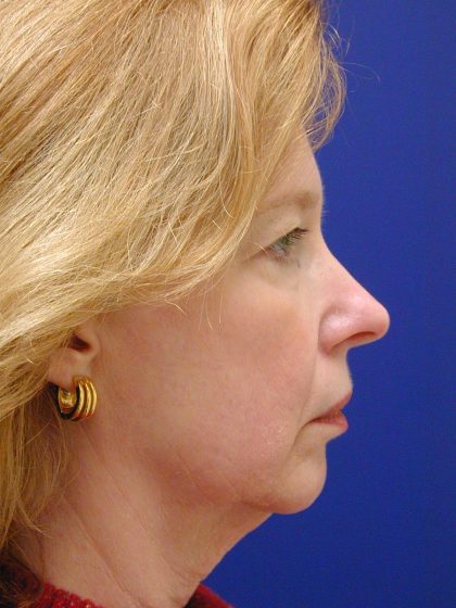 Face/Neck Lift Before & After Patient #8380