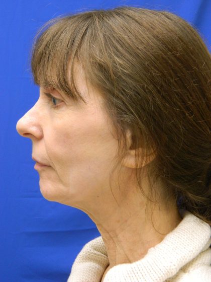 Face/Neck Lift Before & After Patient #8304