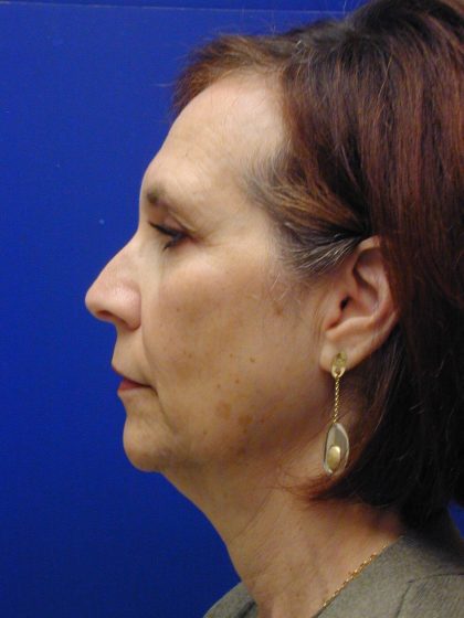 Face/Neck Lift Before & After Patient #8446
