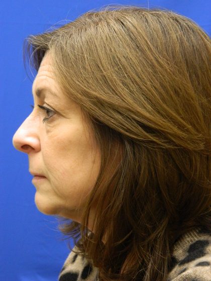 Face/Neck Lift Before & After Patient #8459