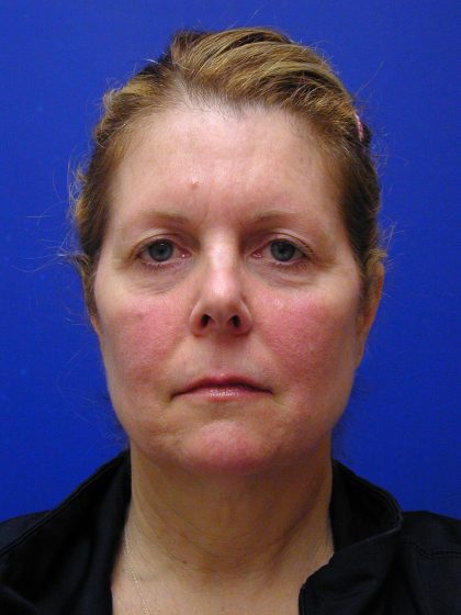 Face/Neck Lift Before & After Patient #8385