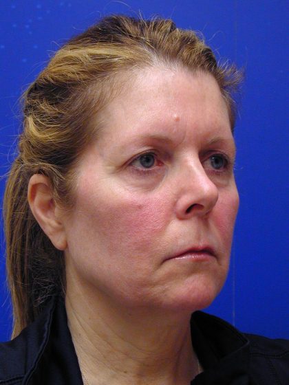 Face/Neck Lift Before & After Patient #8385