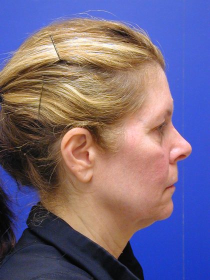 Face/Neck Lift Before & After Patient #8385