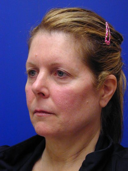 Face/Neck Lift Before & After Patient #8385