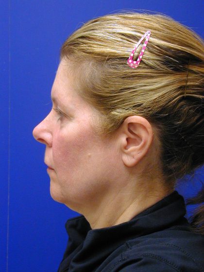 Face/Neck Lift Before & After Patient #8385