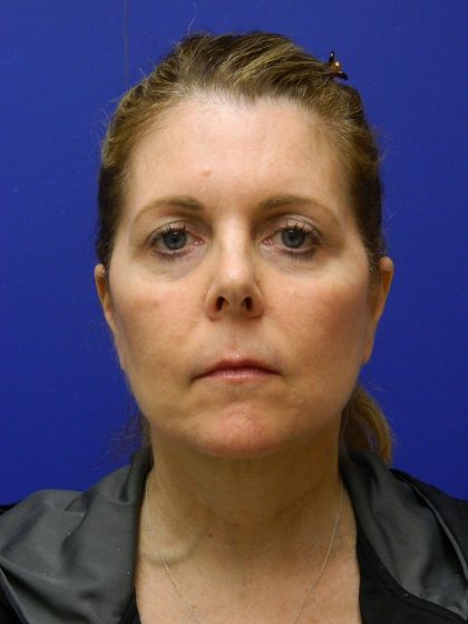 Face/Neck Lift Before & After Patient #8385