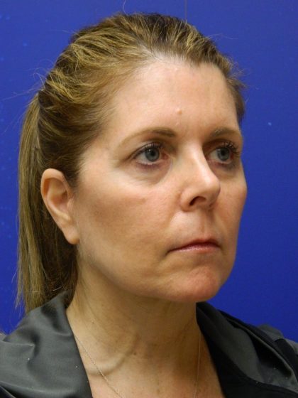 Face/Neck Lift Before & After Patient #8385