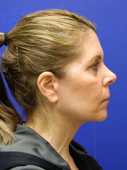 Face/Neck Lift Before & After Patient #8385