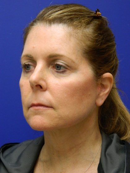 Face/Neck Lift Before & After Patient #8385
