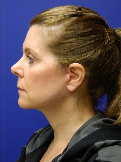 Face/Neck Lift Before & After Patient #8385