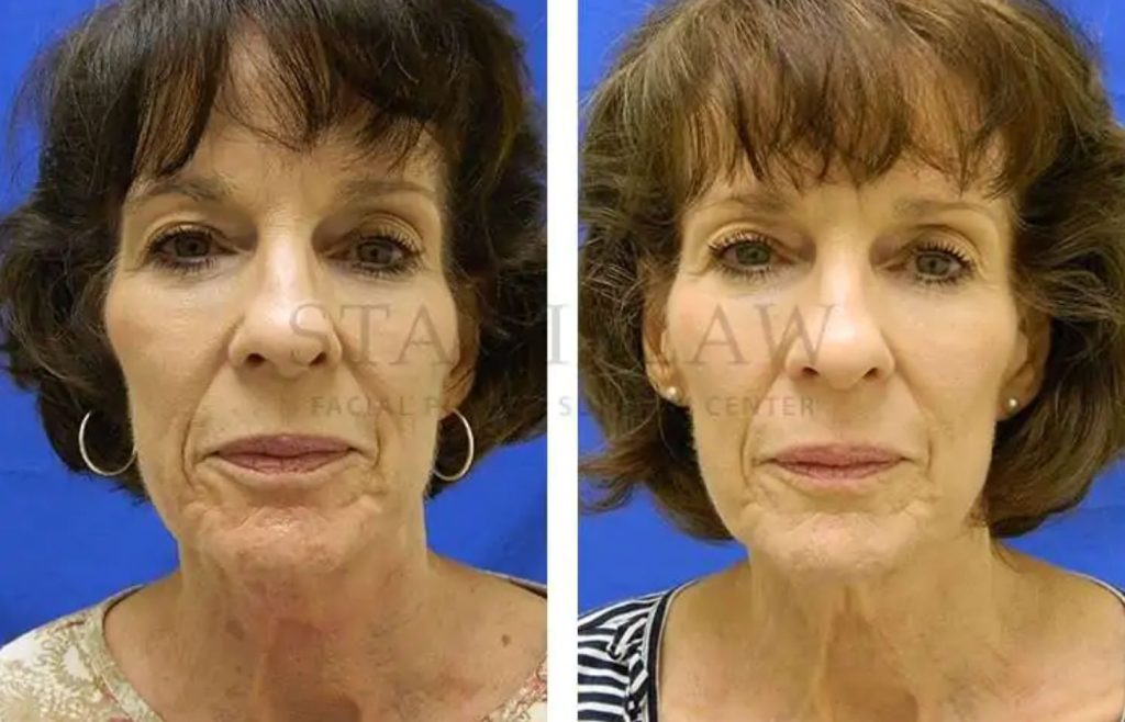 Collagen Induction Therapy (CIT)