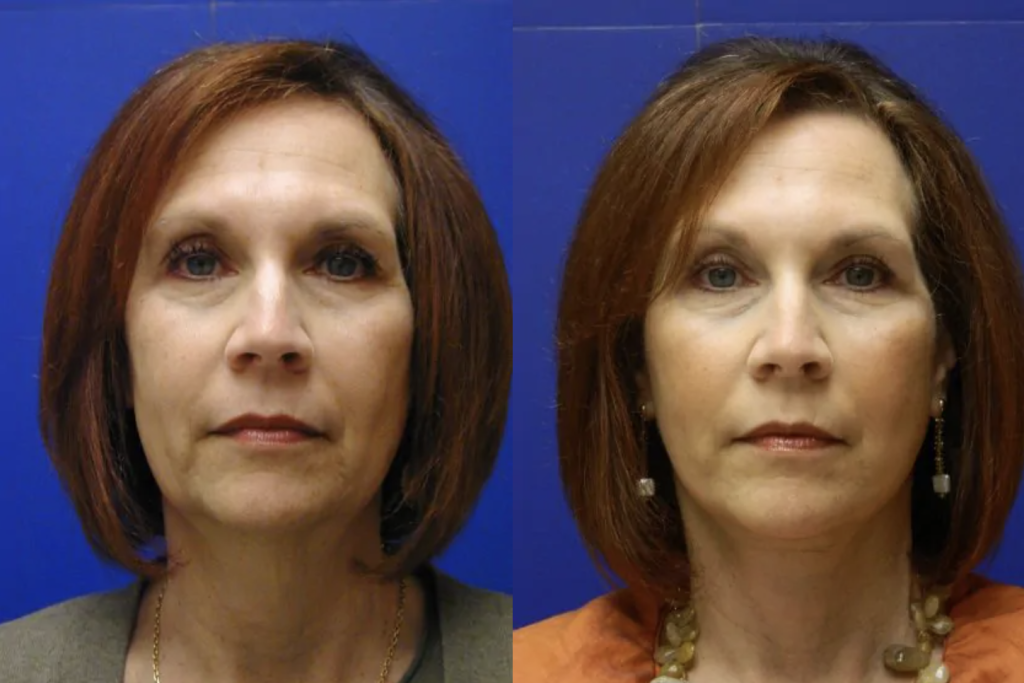 Superficial Wrinkling