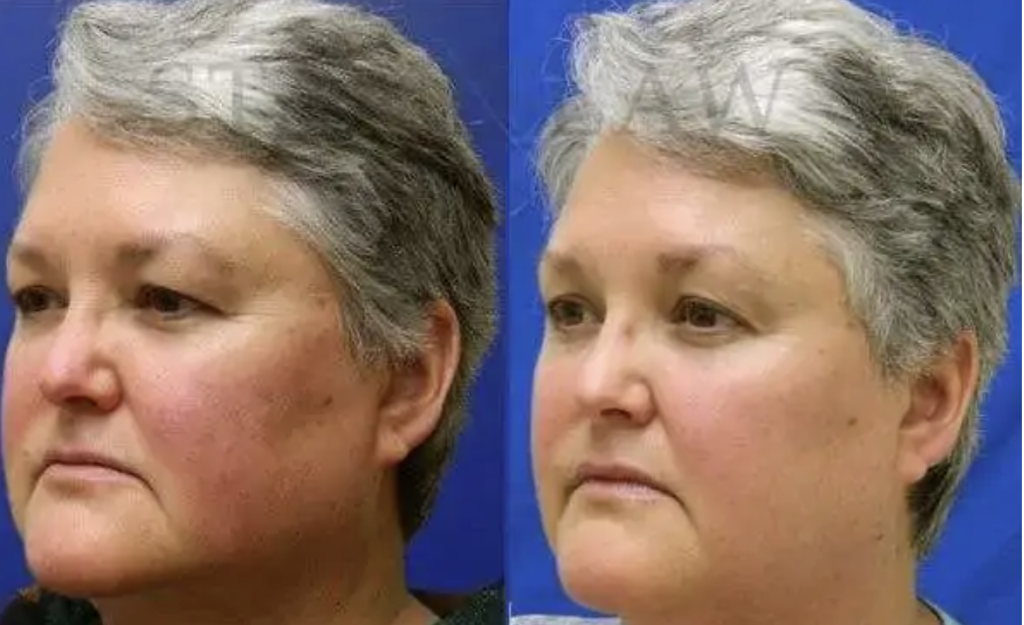 Pulsed Dye Laser