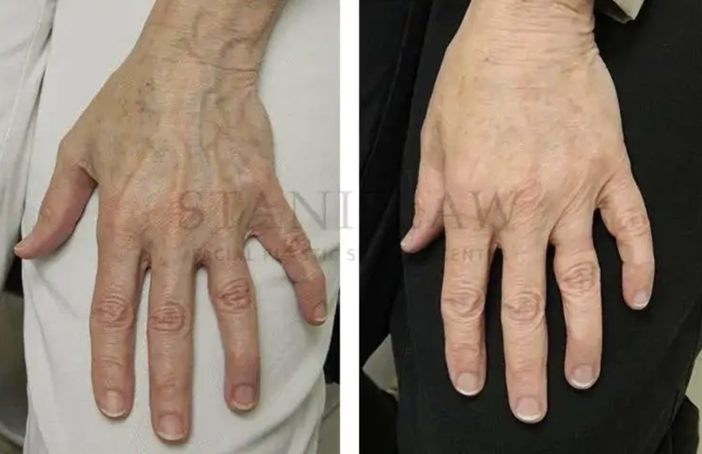 Spider Vein Treatment