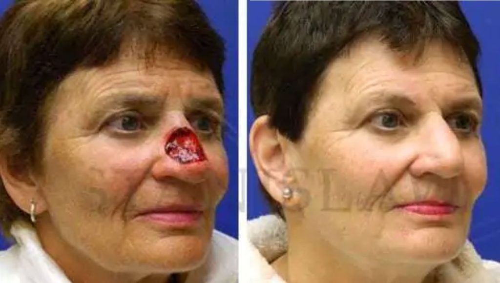 Skin Cancer Removal