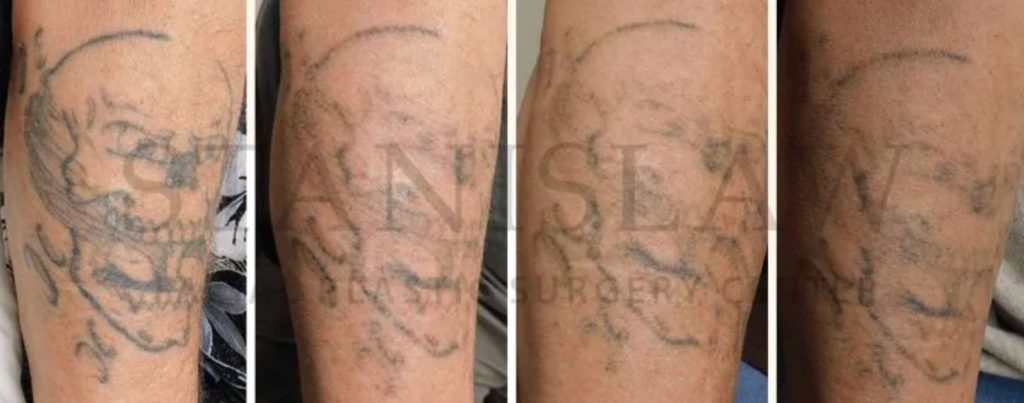 Laser Tattoo Removal