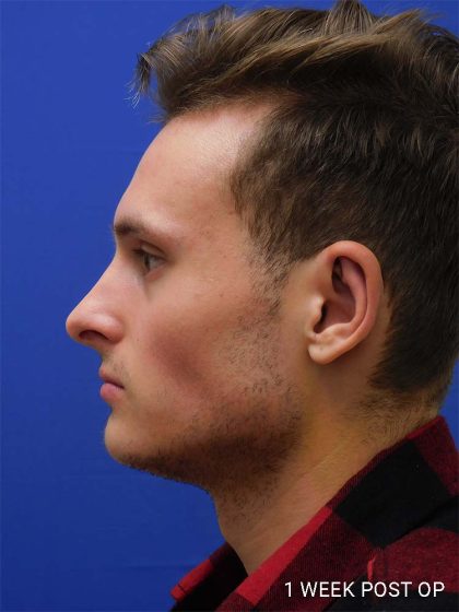 Otoplasty Before & After Patient #1000