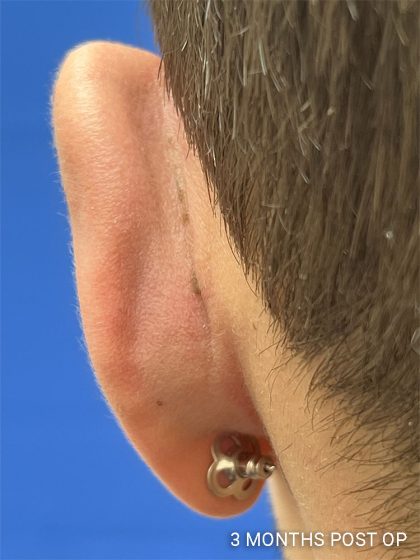 Otoplasty Before & After Patient #1000