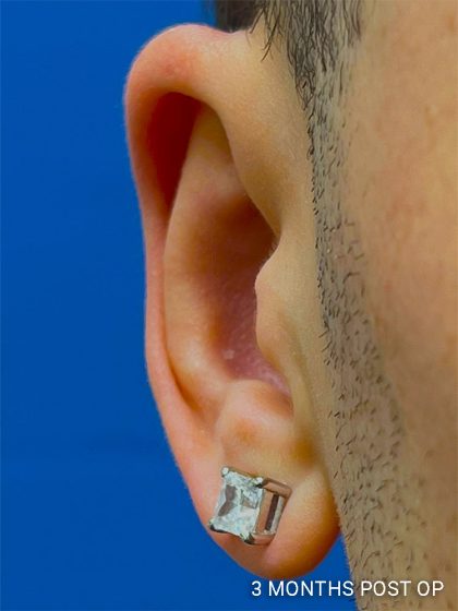 Otoplasty Before & After Patient #1000