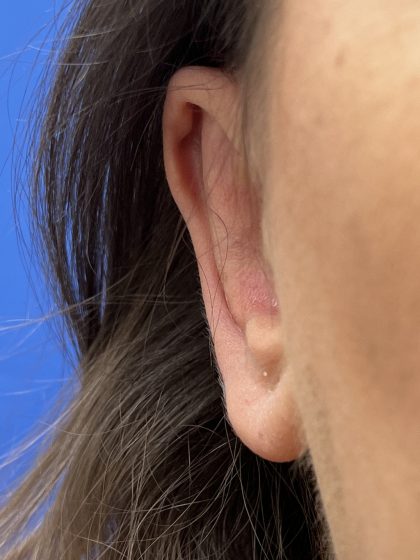 Otoplasty Before & After Patient #9409