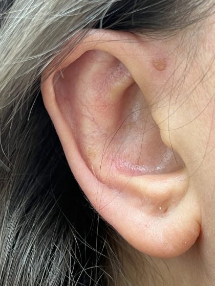 Otoplasty Before & After Patient #9409