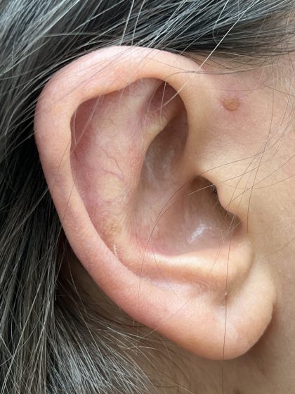Otoplasty Before & After Patient #9409
