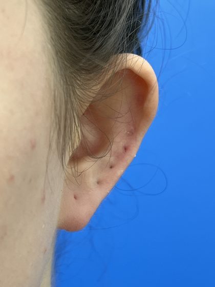 Otoplasty Before & After Patient #9410
