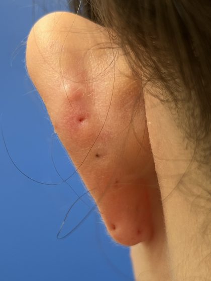 Otoplasty Before & After Patient #9410