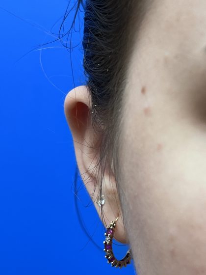 Otoplasty Before & After Patient #9410