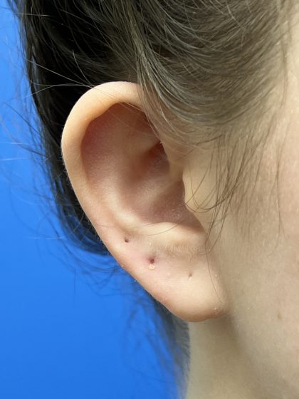 Otoplasty Before & After Patient #9410