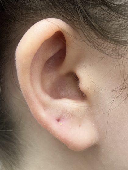 Otoplasty Before & After Patient #9410