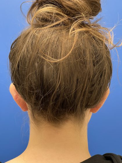 Otoplasty Before & After Patient #9410