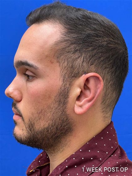 Otoplasty Before & After Patient #993