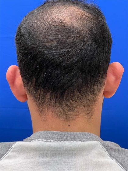 Otoplasty Before & After Patient #993