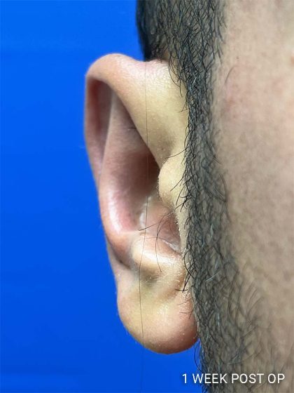 Otoplasty Before & After Patient #993
