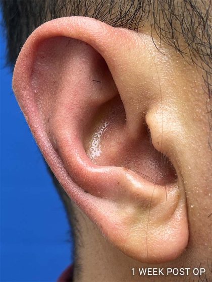 Otoplasty Before & After Patient #993