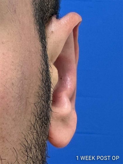 Otoplasty Before & After Patient #993