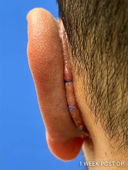 Otoplasty Before & After Patient #993